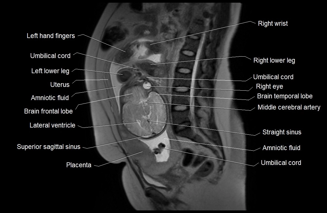 MRI fetal anatomy sagittal image 20.webp